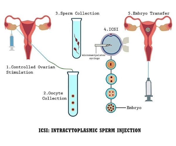 Intracytoplasmic Sperm Injection (icsi)